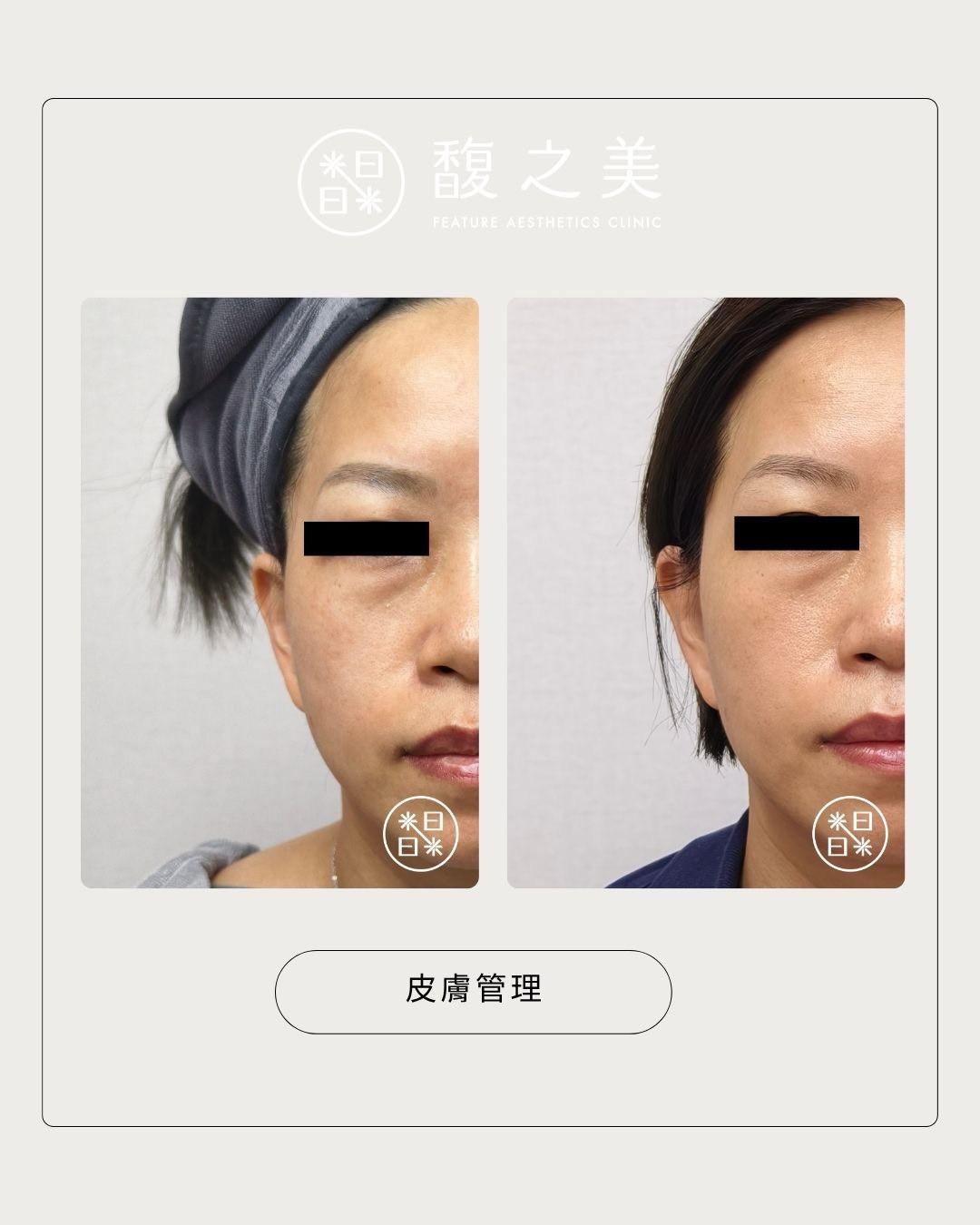 皮膚管理 - 馥之美診所美麗見證