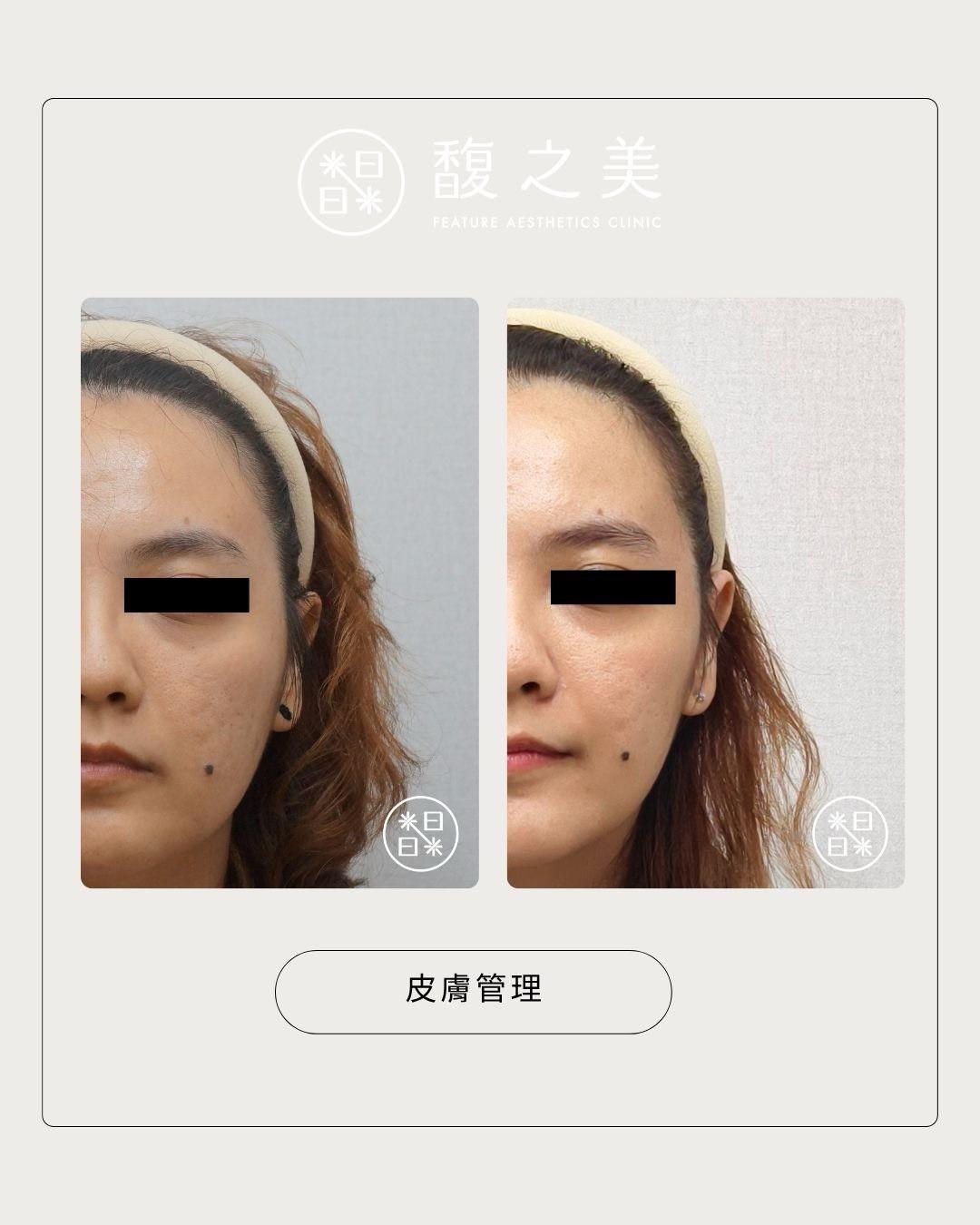 皮膚管理 - 馥之美診所美麗見證