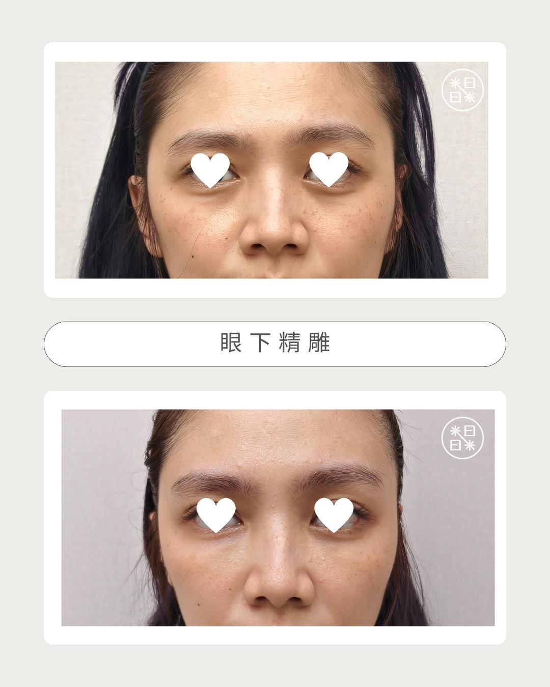熊貓眼 - 馥之美診所美麗見證