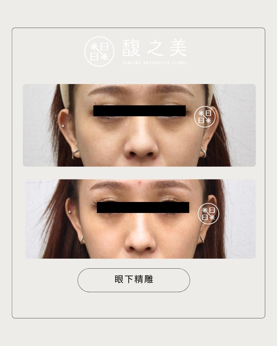 熊貓眼 - 馥之美診所美麗見證