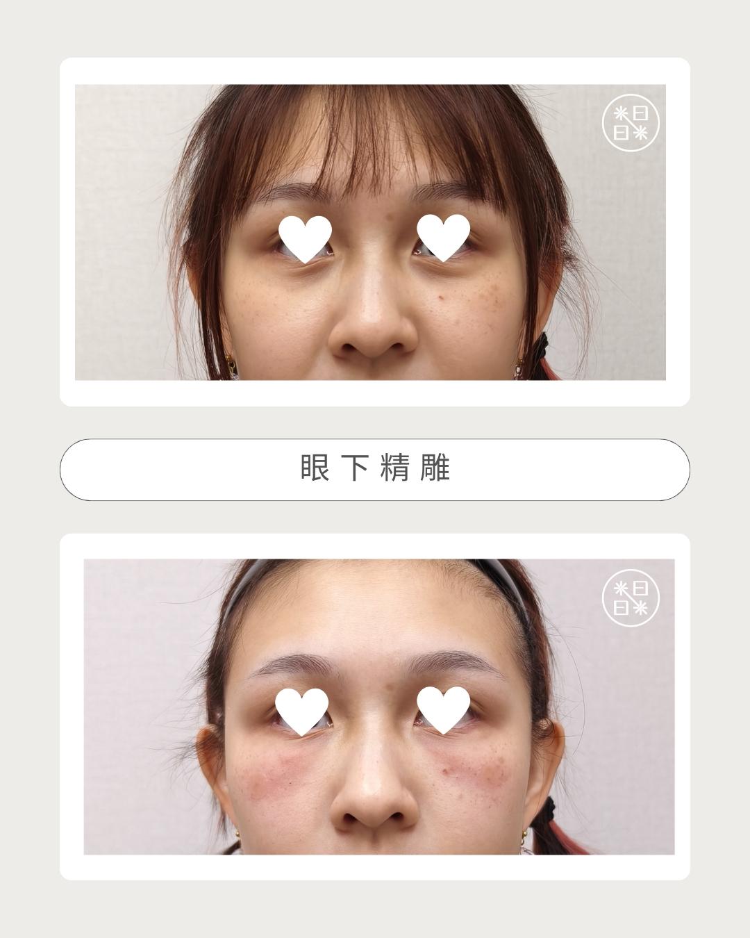 熊貓眼 - 馥之美診所美麗見證