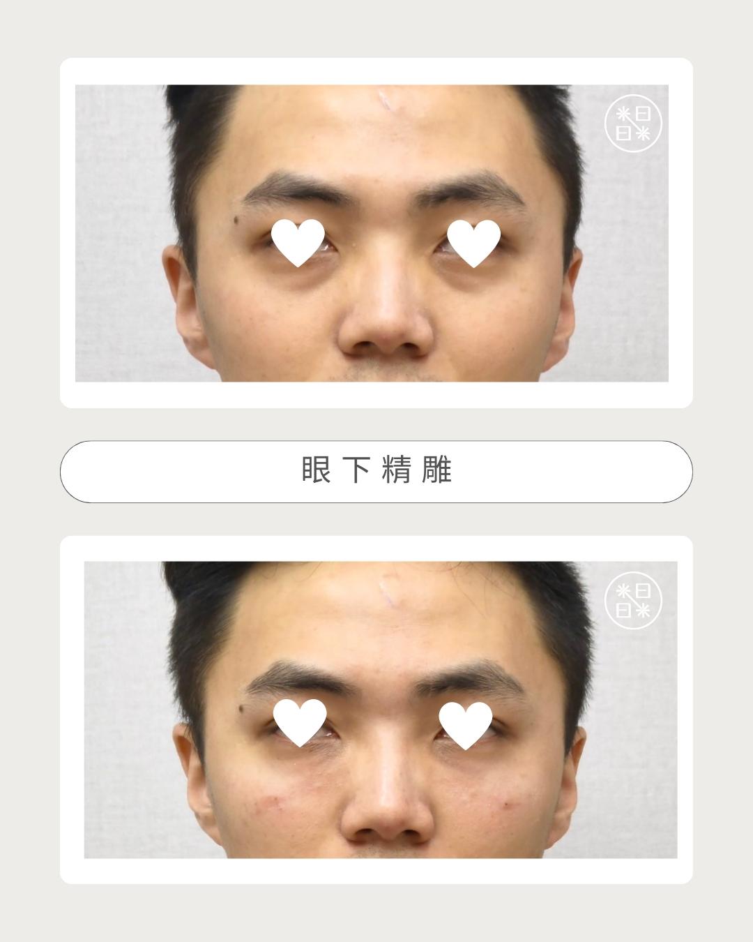 熊貓眼 - 馥之美診所美麗見證