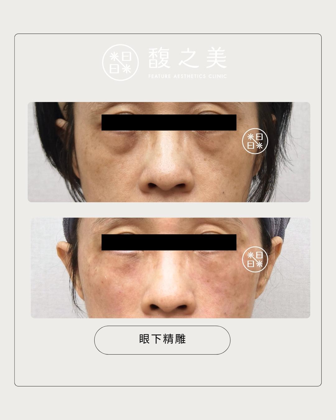 熊貓眼 - 馥之美診所美麗見證