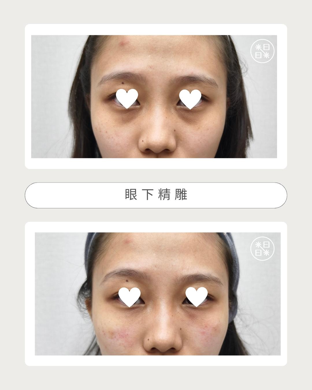 熊貓眼 - 馥之美診所美麗見證