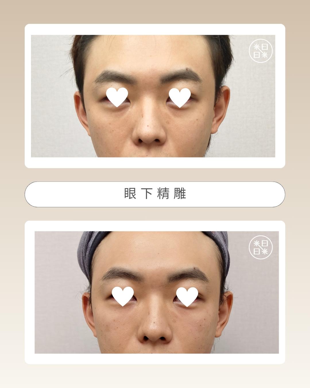 熊貓眼 - 馥之美診所美麗見證