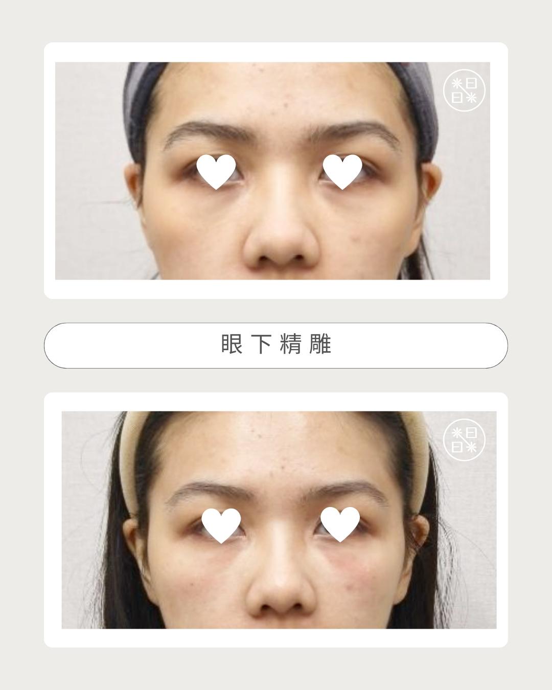 熊貓眼 - 馥之美診所美麗見證