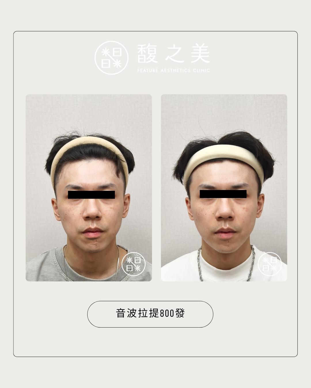 緊緻拉提 - 馥之美診所美麗見證