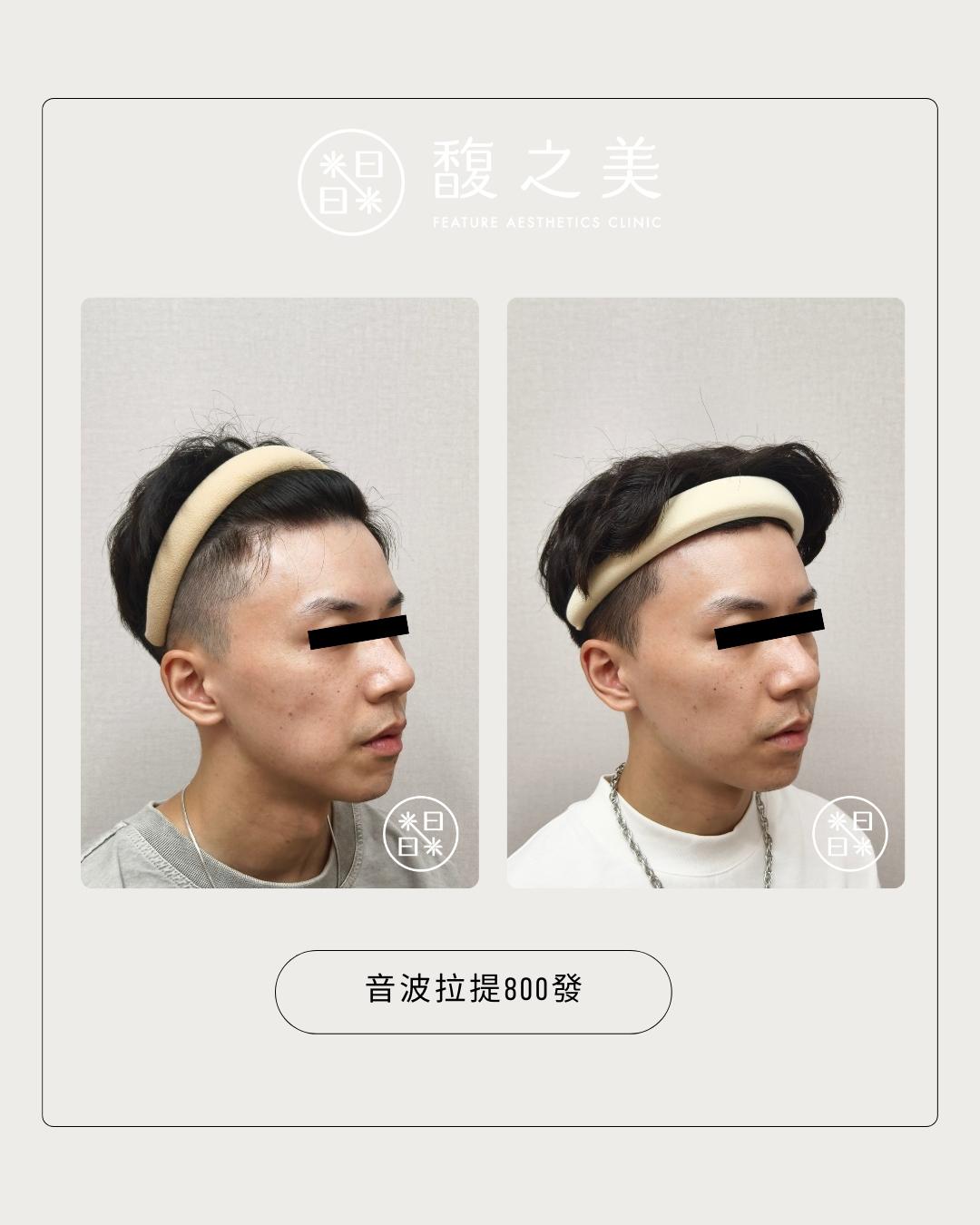緊緻拉提 - 馥之美診所美麗見證