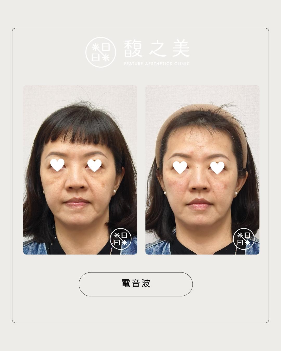 緊緻拉提 - 馥之美診所美麗見證