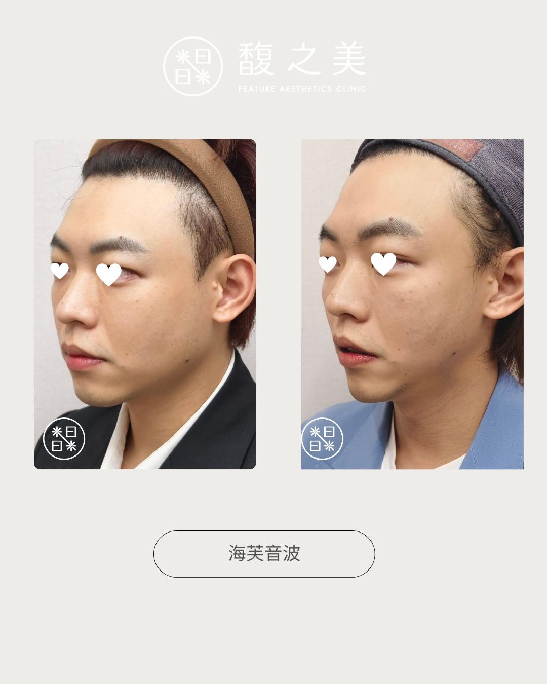 緊緻拉提 - 馥之美診所美麗見證