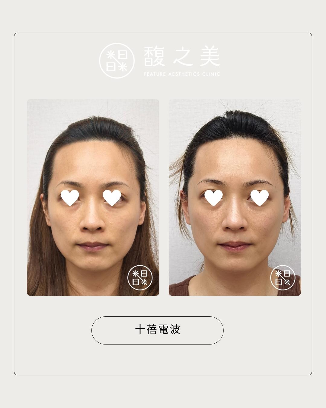 緊緻拉提 - 馥之美診所美麗見證