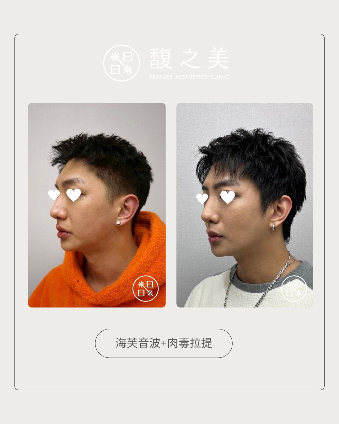 緊緻拉提 - 馥之美診所美麗見證