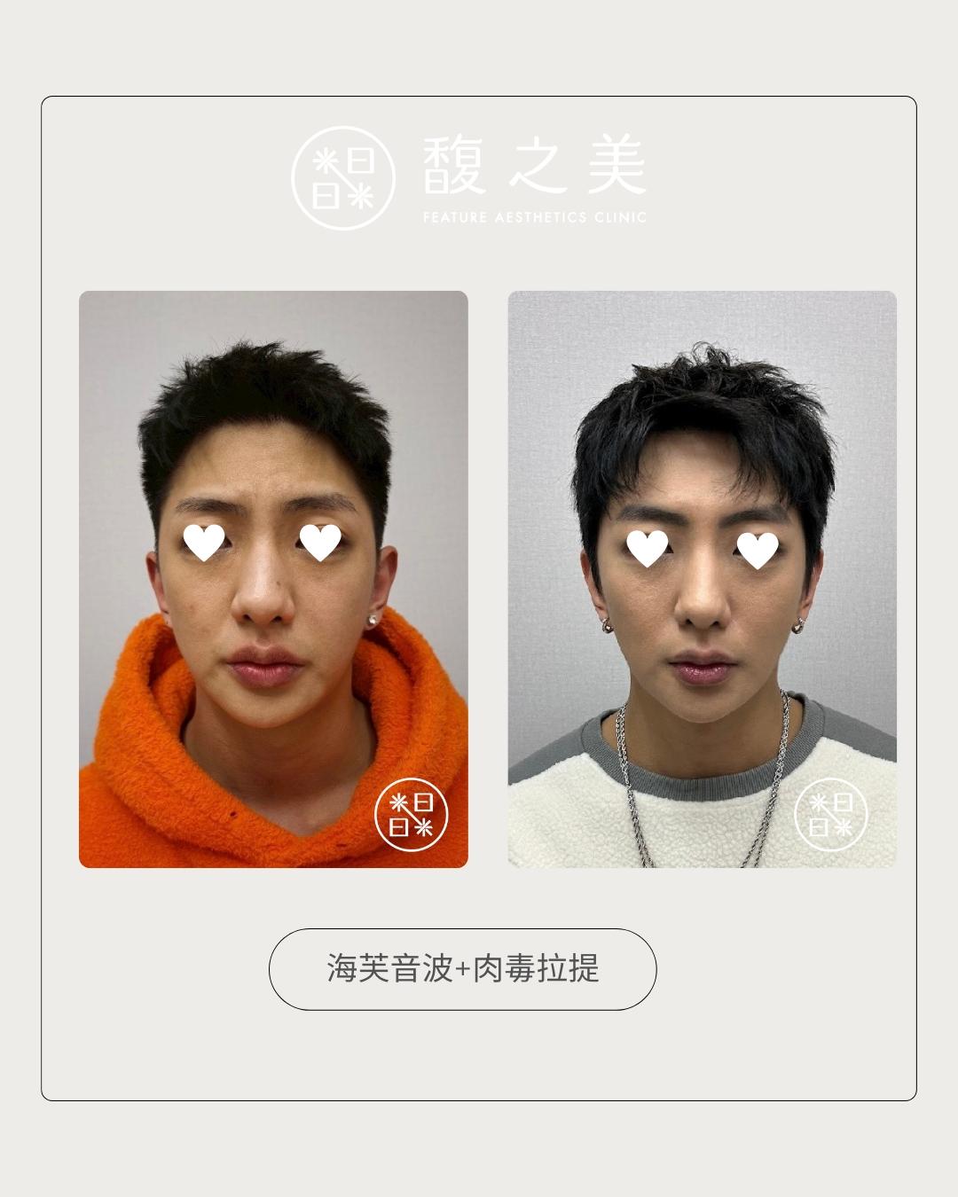 緊緻拉提 - 馥之美診所美麗見證