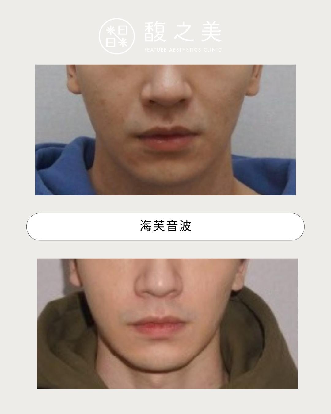 緊緻拉提 - 馥之美診所美麗見證
