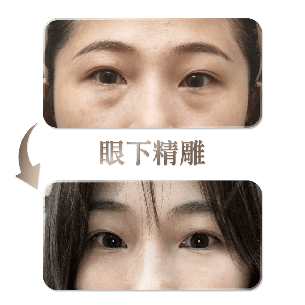 眼下精雕療程案例紀錄，上下對照呈現眼周與眼下輪廓狀態。
