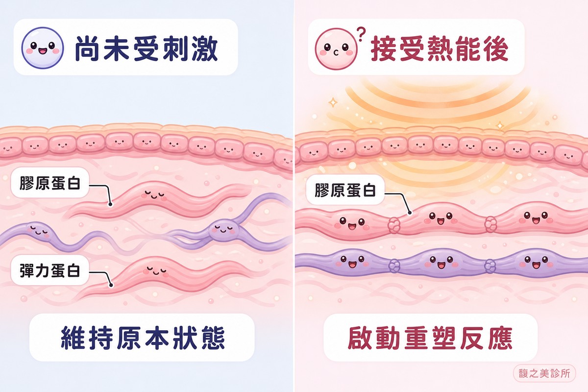 射頻熱效應刺激皮膚組織重塑的作用原理