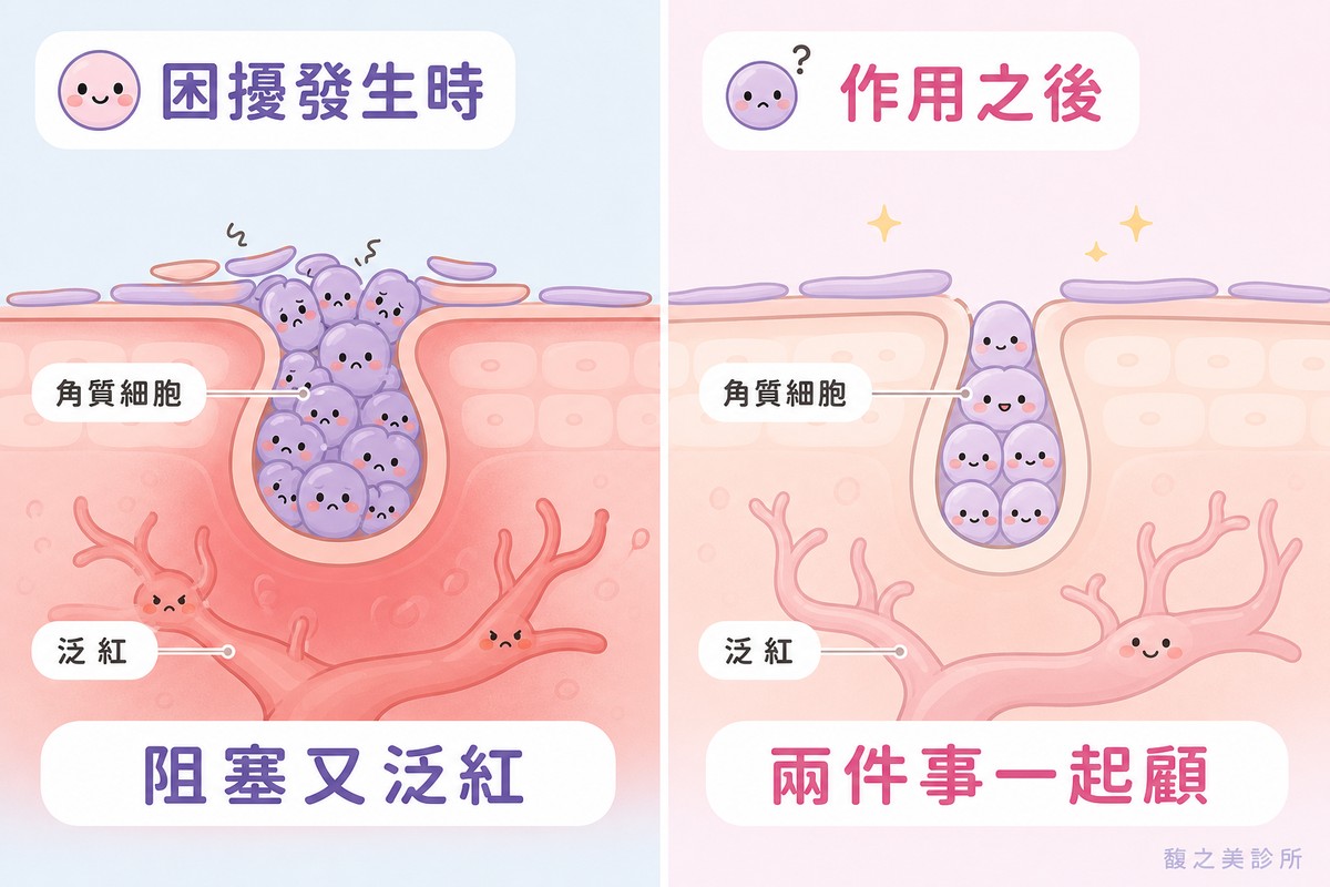 左右對照的機轉插圖。左邊標「困擾發生時」，畫毛孔剖面，角質細胞小角色擠在出口、表情困擾，周圍帶明顯的柔和紅色調，下方結論寫「阻塞又泛紅」；右邊標「作用之後」，畫同樣的毛孔剖面，角質細胞小角色排列變得有序、出口通暢，周圍的紅色調明顯轉淡，下方結論寫「兩件事一起顧」。
