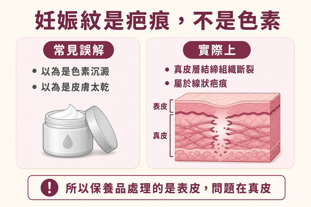 左右對照圖，左側列出常見誤解為色素沉澱與皮膚乾燥，右側以皮膚剖面顯示真皮層結締組織斷裂
